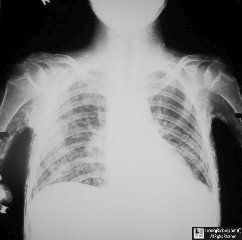 Calcinosis universalis